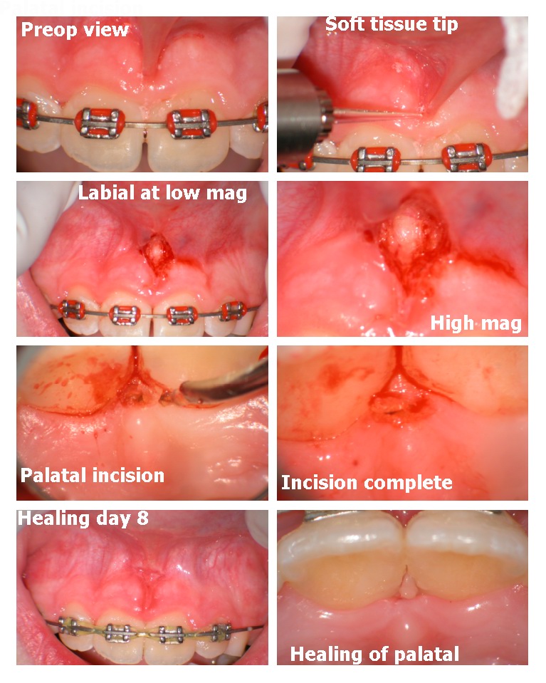 Frenectomy 3.jpg